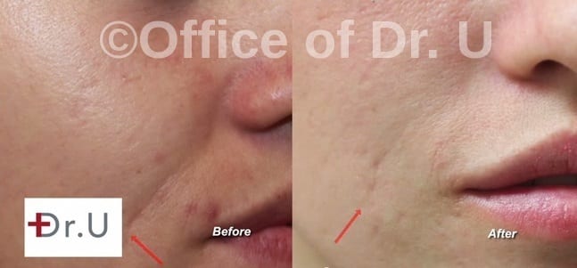 Laugh Line Reduction Before and after photos in a Manhattan Beach Los Angeles Patient of Dr U