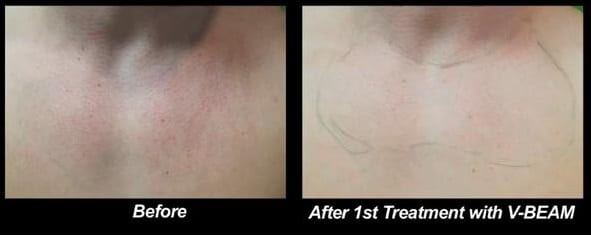 Wondering "what can I do for rosacea?" After one session with Dr. U and the V-BEAM laser this patient already noticed significant progress.* Wondering "what can I do for rosacea?" After one session with Dr. U and the V-BEAM laser this patient already noticed significant progress.*