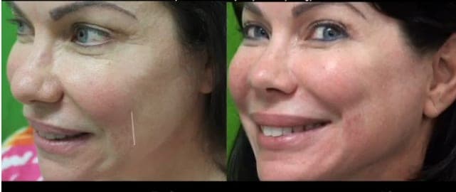 Belotero Fine smile lines or smile wrinkle treatment before and after in a Manhattan Beach Los Angeles patient of Dr U