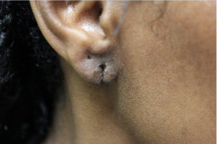 This patient came to Dr. Umar with a completely ripped earlobe.