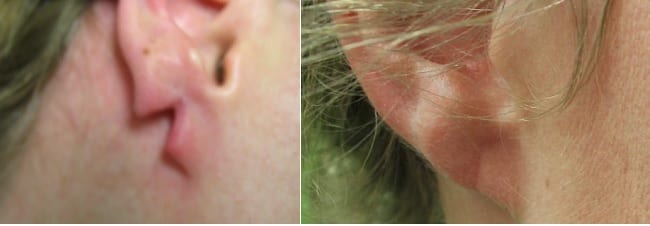 This split earlobe repair by Dr. Umar was a huge transformation. This patient no longer brings unwanted attention to her ears.*