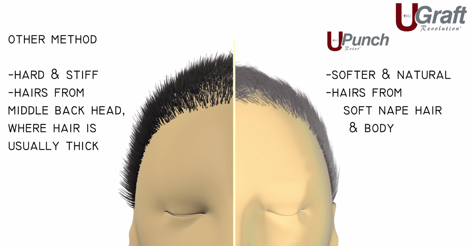 Dr.UGraft FUE Repair Procedure