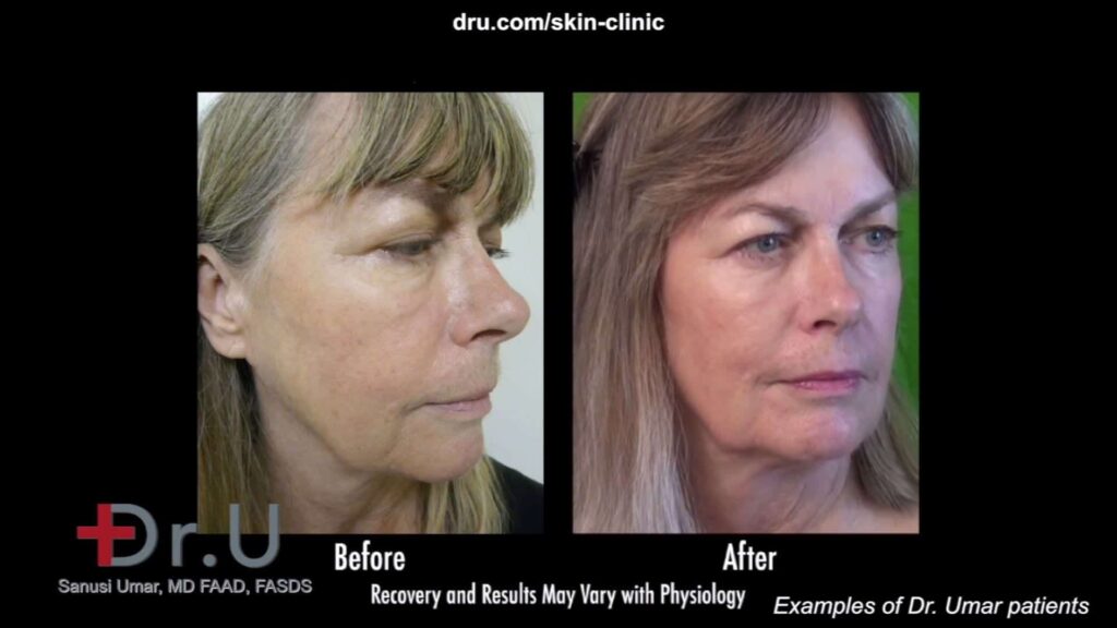Non surgical liquid facelift using Radiesse and botox by Dr U prevents the need for a facelift
