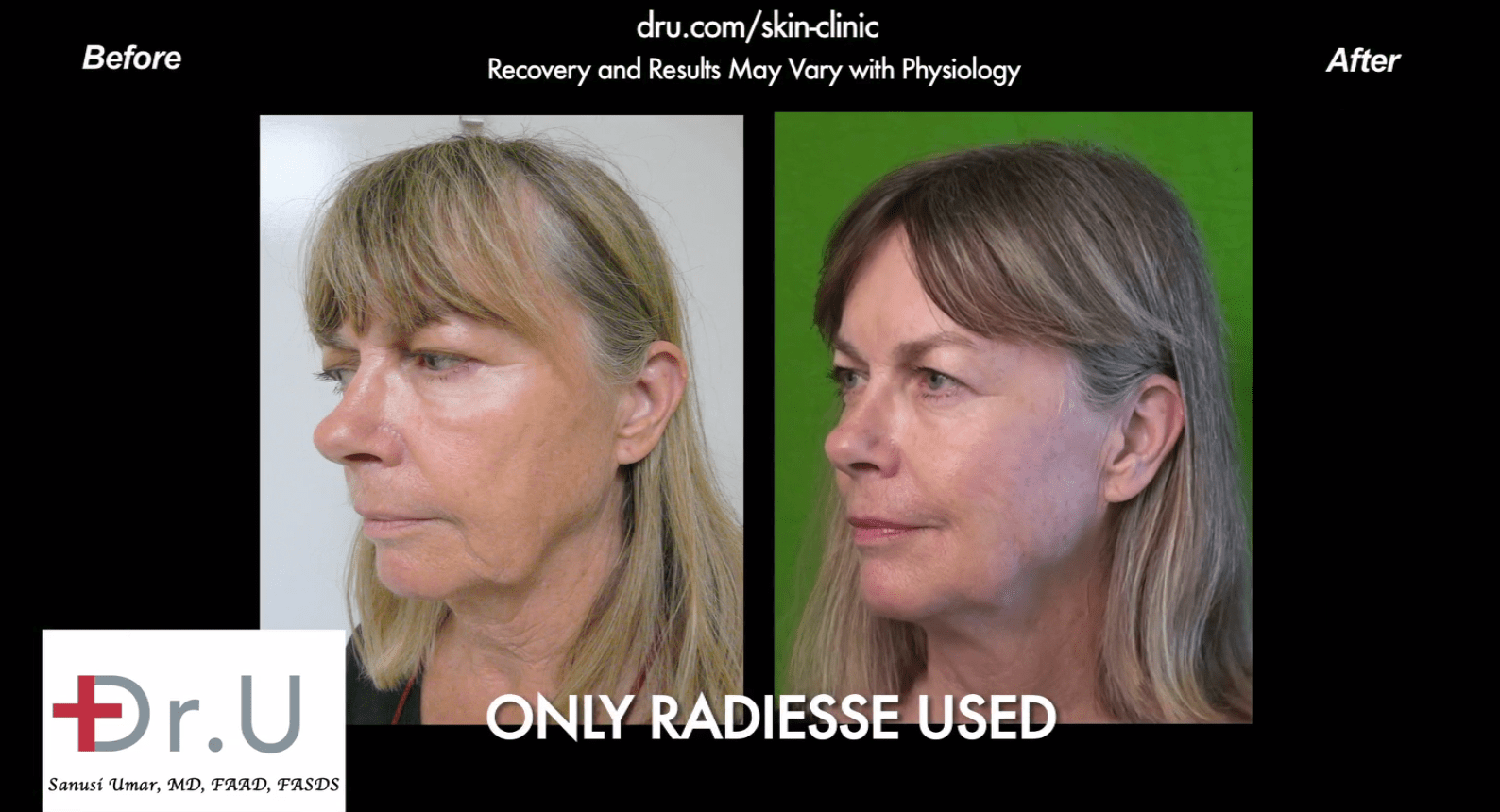 This patient used radiesse for a jowl reduction without surgery*