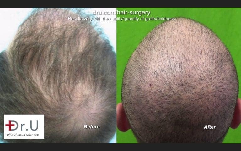 How to get rid of hair transplant scars: Before and After DrUGraft to fix previous hair transplant