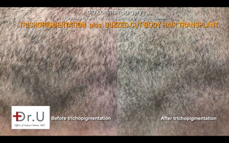 Hair transplant scar cover up by DrUGraft BHT & SMP.
