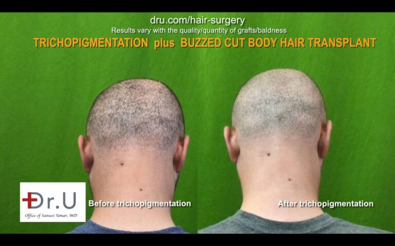 Shaved head after FUE by Dr.UGraft and Scalp Micropigmentation SMP achieved look of density in Santa Monica Los Angeles Patient.