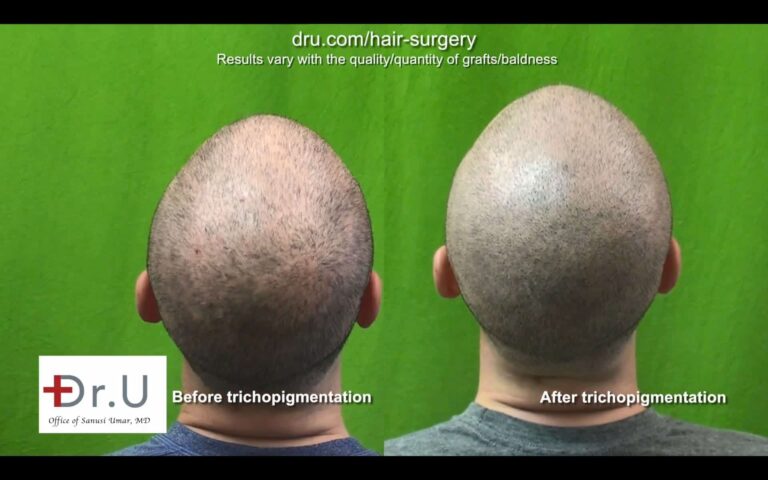 Get rid of hair transplant scar with Dr.UGraft FUE and SMP combination.