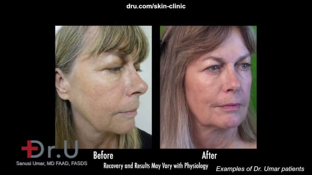 non surgical jowl lift In beverly hills patient