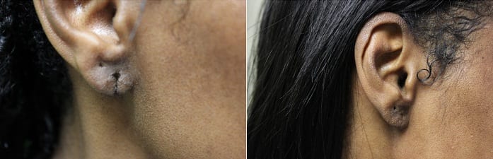 Thanks to Dr. Umar, this patient now has a regular looking earlobe with minimal scarring. She is now also able to re-pierce her ears (in a separate spot) if she wishes.*