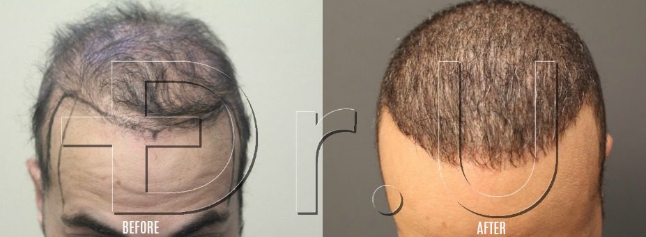 Before and after pictures of the top of the head. Before and after pictures of the top of the head.