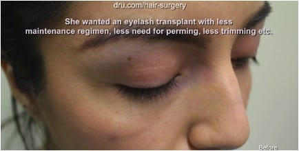  Weak and thinning temple points prior to hair transplant correction using DrUGraft