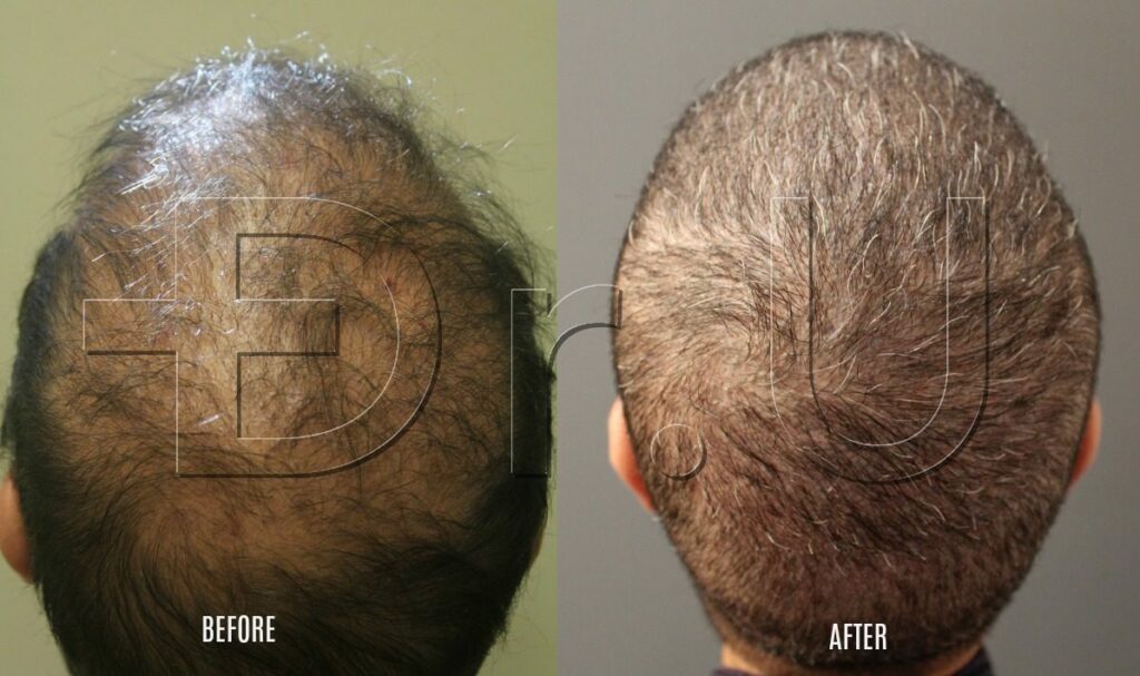 Taking hair from the arms and other parts of the body. Taking hair from the arms and other parts of the body.