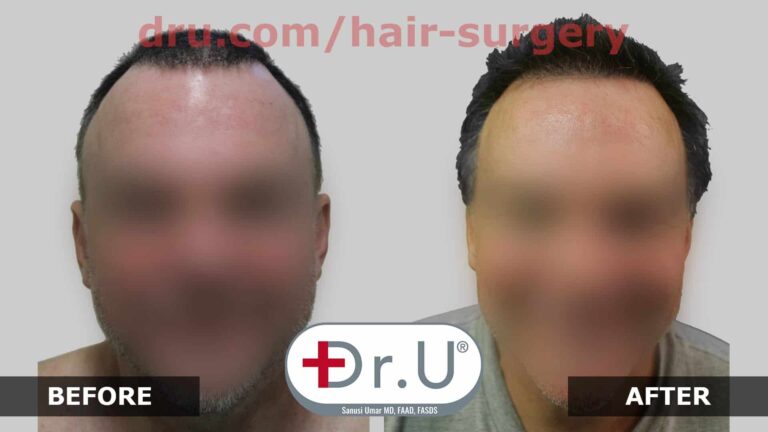 Dr.UGraft FUE Restoration: Before and After Photos