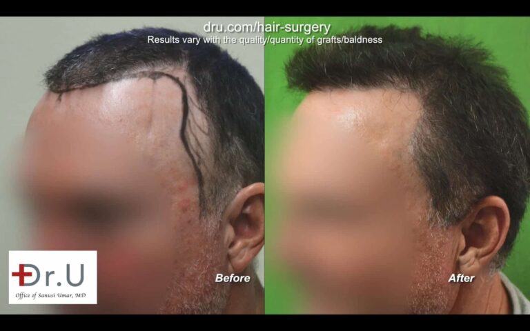 Dr.UGraft FUE Restoration: Before and After Photos