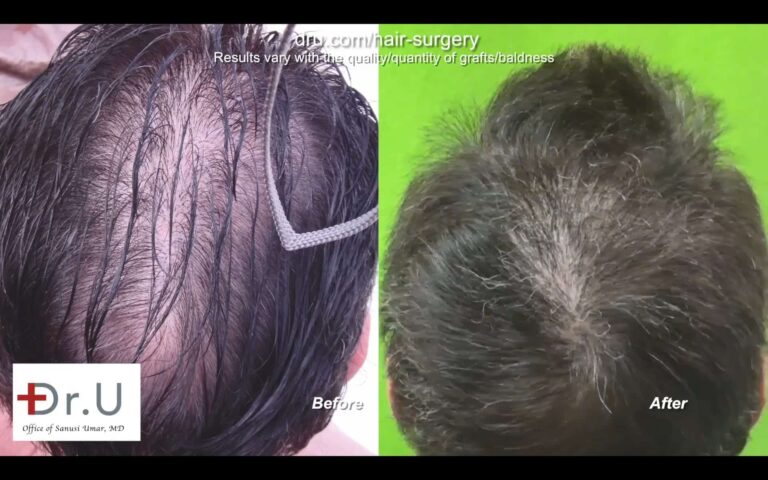 Dr.UGraft FUE Restoration: Before and After Photos