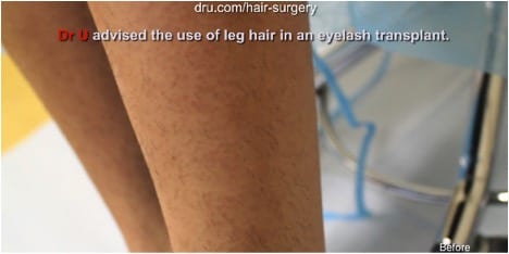Beverly Hill's patient with visible scarring caused by surgery performed by another clinic .