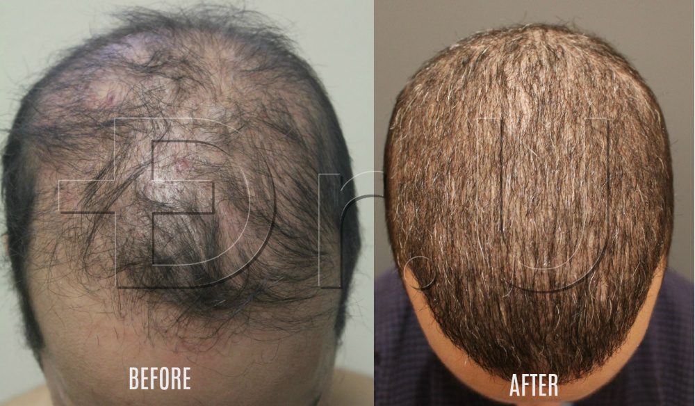 Top view of patient's scalp showing the insertion and growth of scalp and body hair to cover the mistakes made by previous strip surgery procedures botched hair transplant repaired with head and body hair