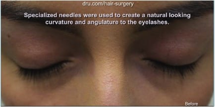  Primary donor area for the Dr.UGraft corrective hair surgery