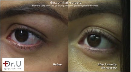  Highly visible linear wound required a repair surgery to cover this strip scar