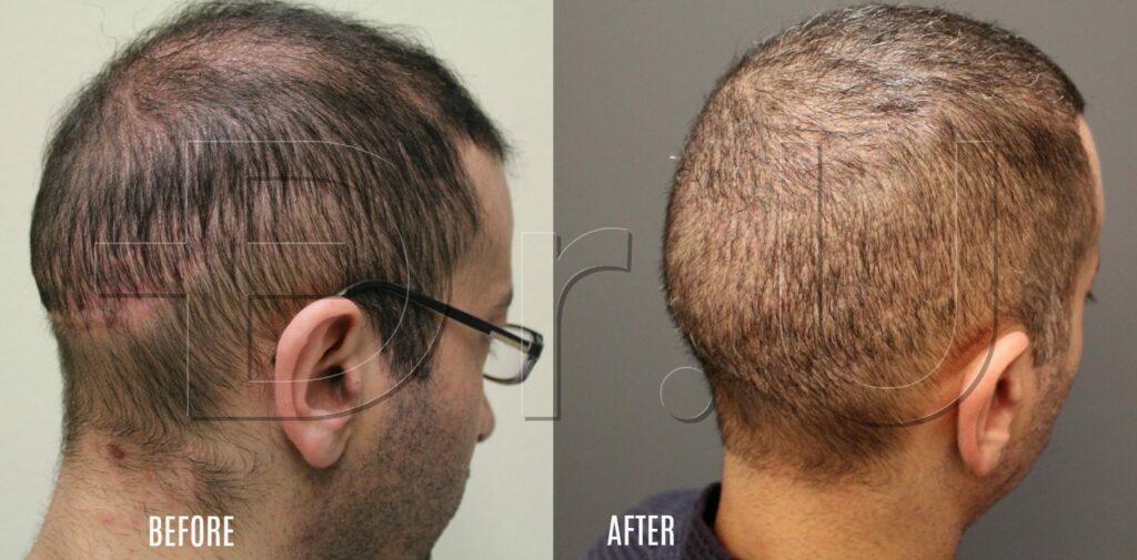 Wide strip scar repaired using scalp and body hair Wide strip scar repaired using scalp and body hair