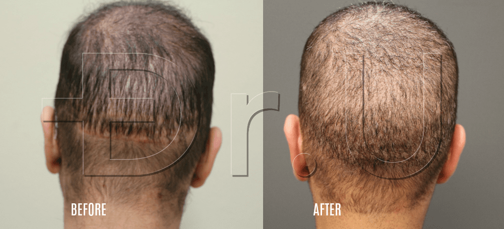 Rear view of wide strip scar repaired with head and non-head hair Rear view of wide strip scar repaired with head and non-head hair