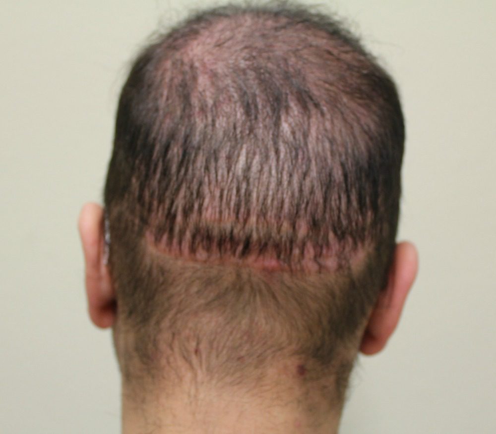 The double scar from a botched hair transplant surgery. The double scar from a botched hair transplant surgery.