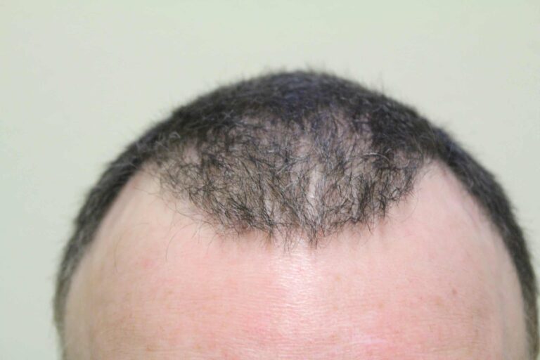 Previous bad hair surgery outcome