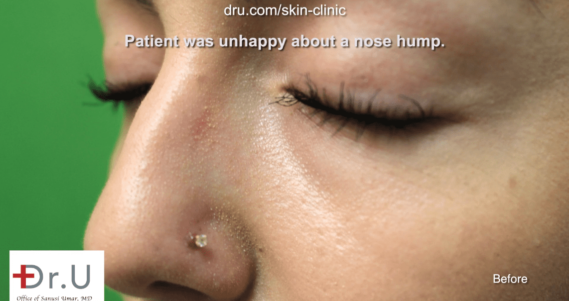 The patient before nose bump removal without surgery. * The patient before nose bump removal without surgery.