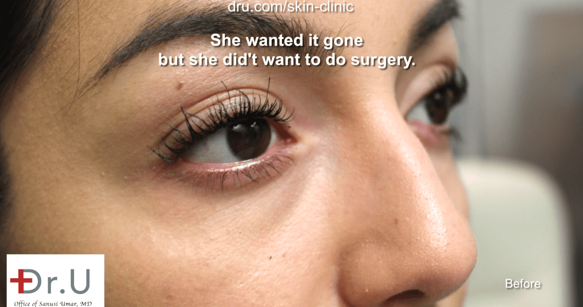 Beverly Hills patient went to see Dr. U about bump on the nose removal * Beverly Hills patient went to see Dr. U about bump on the nose removal.