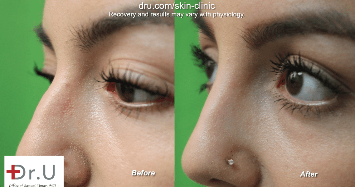 The patient after Radiesse was used as a nose filler for bump.*