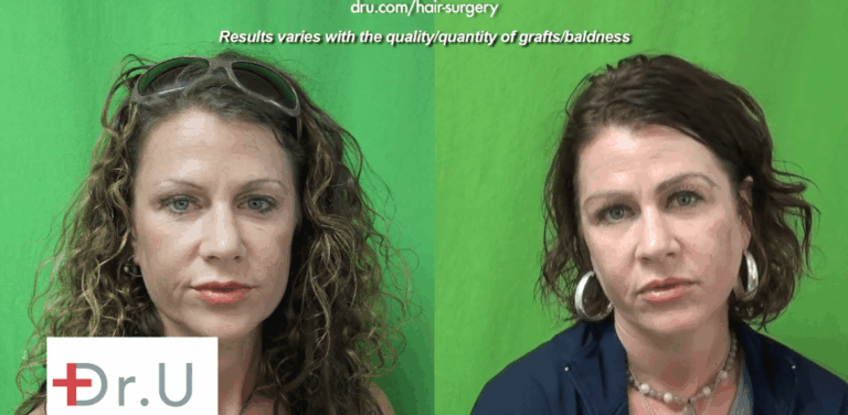 The patient before and after her eyebrow transplant which achieved the thick shaped eyebrows that she hoped for Manhattan Beach patient before and after her eyebrow transplant which achieved the thick shaped eyebrows that she hoped for