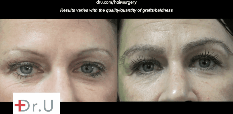 Before and after eyebrow transplant.* Before and after eyebrow restoration surgery with nape hair showing the thick shaped eyebrows inspired by Kim Kardashian