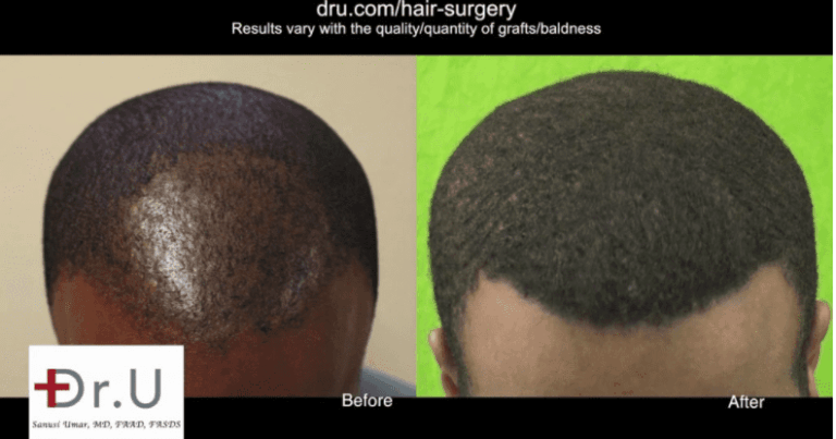 Black celebrity hair loss solution with Dr.UPunch Curl Black celebrity hair loss solution with Dr.UPunch Curl