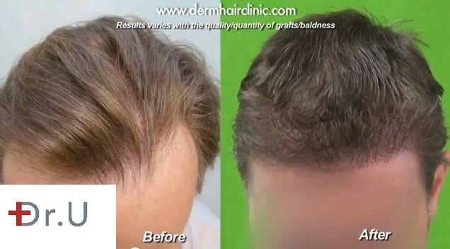 Before and After A 3000 Graft FUE Procedure