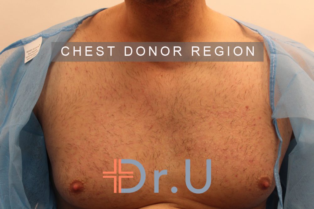 Patient's chest helped provide additional donor grafts for his follow up hair transplant repair surgery, performed by Dr.U The chest was used to help supply additional donor grafts for patient's hair transplant procedure