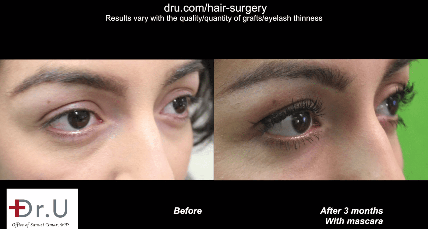 Dr.U was able to create natural looking curvature and angles for the transplanted lashes. This eyelash surgery before and after photo is from 3 months after the transplant.*