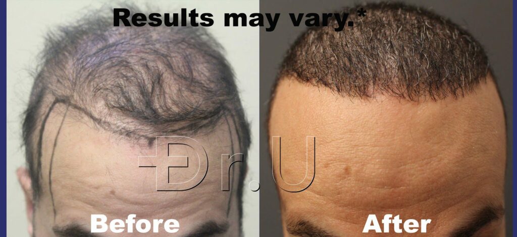 Facial and body hair is a proven solution for patients with insufficient donor hair. Facial and body hair is a proven solution for patients with insufficient donor hair.