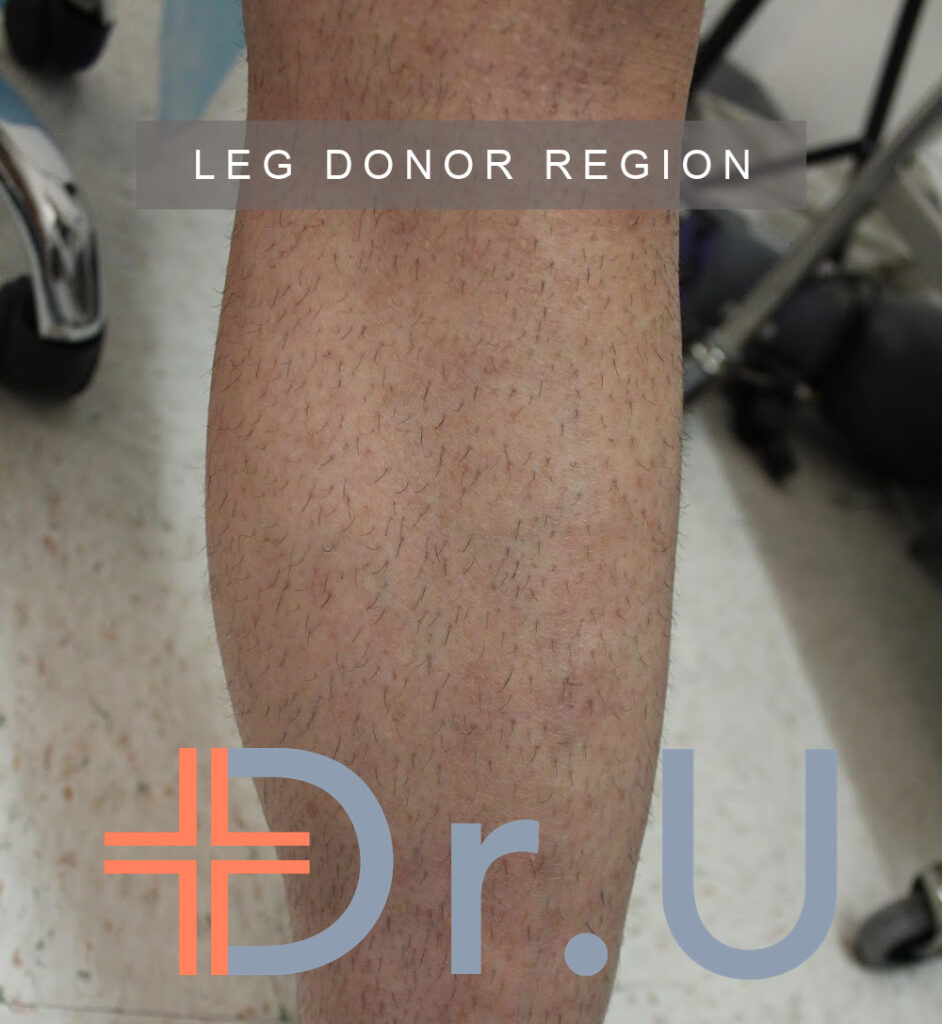 Leg donor area used for body hair transplant patient Leg donor area used for body hair transplant patient