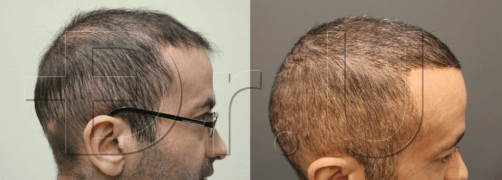 Side profile view of patient’s hair restoration repair using both body and scalp hair * Side profile view of patient’s hair restoration repair using both body and scalp hair *