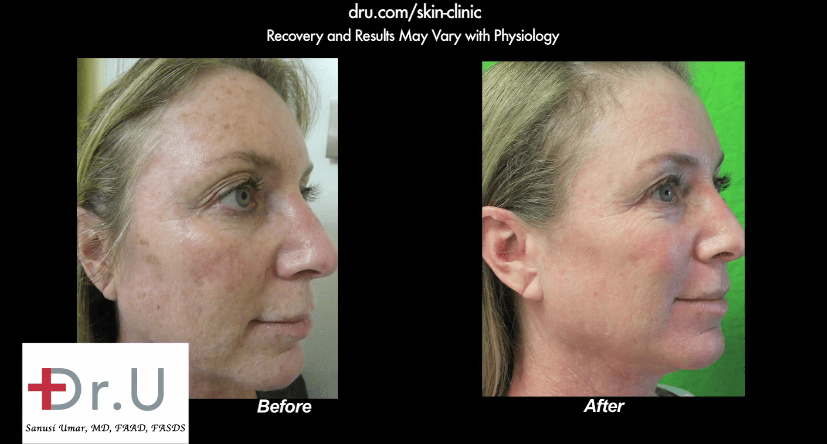 Spectra laser before and after only one session results in dramatic improvement.*