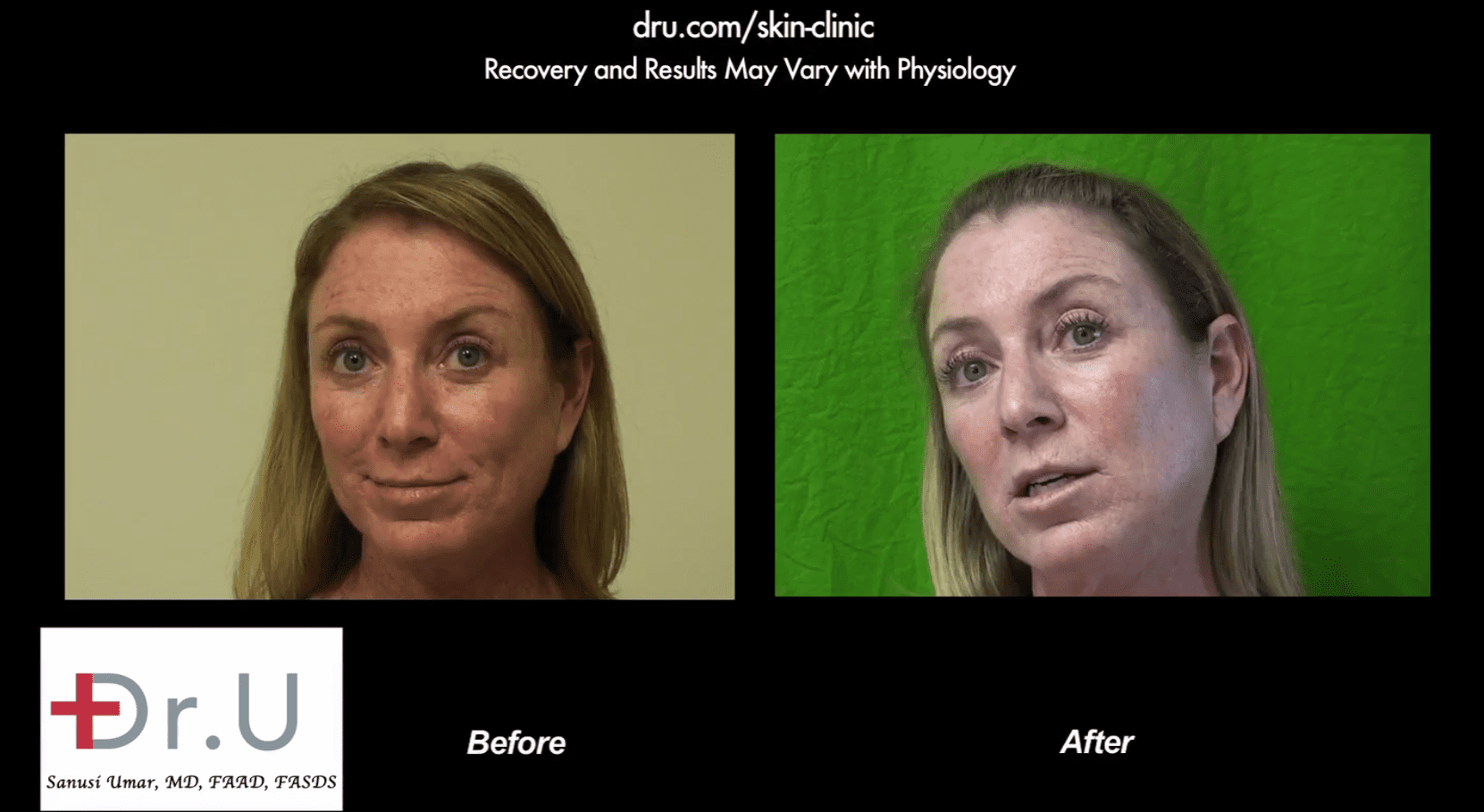 The spectra lazer (laser) results after a single session are already showing incredible improvement.*