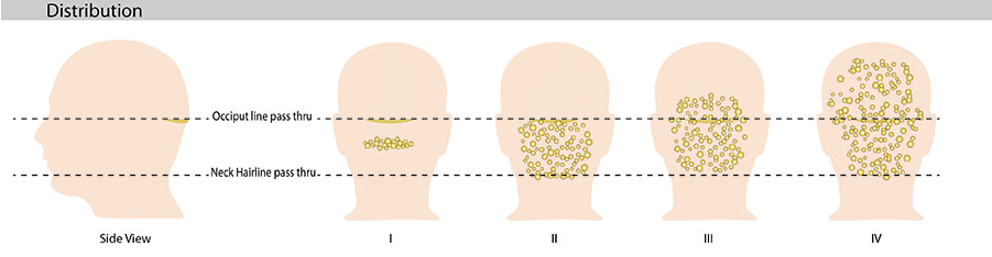 Surgically, the best treatment for acne keloidalis nuchae is stages I and II. 
