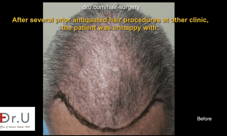 Before Corrective hair surgery with Dr. U Due to the common misconception that older procedures are more reliable, individuals such as the patient above are faced with the problem of repairing older hair restorations results.