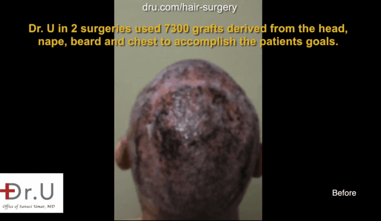 Dr.UPunch Rotor used for hair surgery correction. While other clinics might have turned this Newport Beach man away due to insufficient donor hair on the head, Dr. U used an advanced BHT FUE system to provide more grafts to reduce the appearance of hair plugs and scars from other surgeries.
