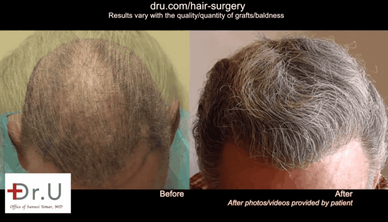 Dr.UGraft allows for a high body hair transplant success rate. Since the patient's donor hair area was depleted from previous scalp reductions and outdated procedures, Dr. Umar extracted body hair with the Dr.UPunch Rotor to ensure a high body hair transplant success rate.