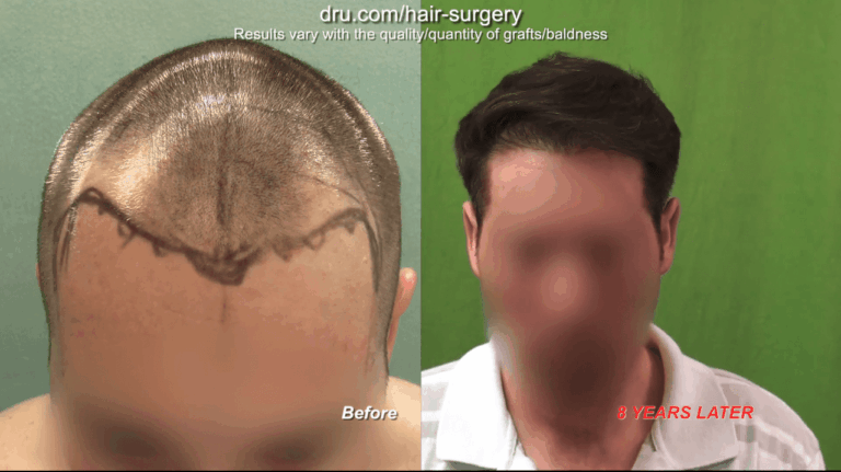 There is not necessarily a best age for a hair transplant if a patient and doctor can work through commonly understood goals and expectations