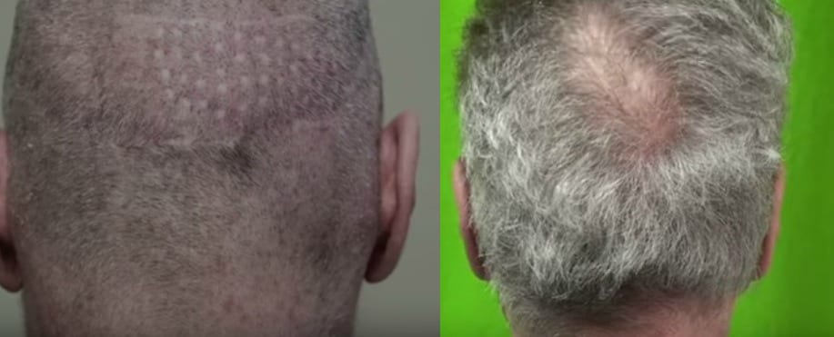 Hair transplant graft count of 6500 follicular units taken from the scalp and beard area to conceal scalp deformities from punch graft procedures, scalp reductions and other failed surgical attempts at hair restoration