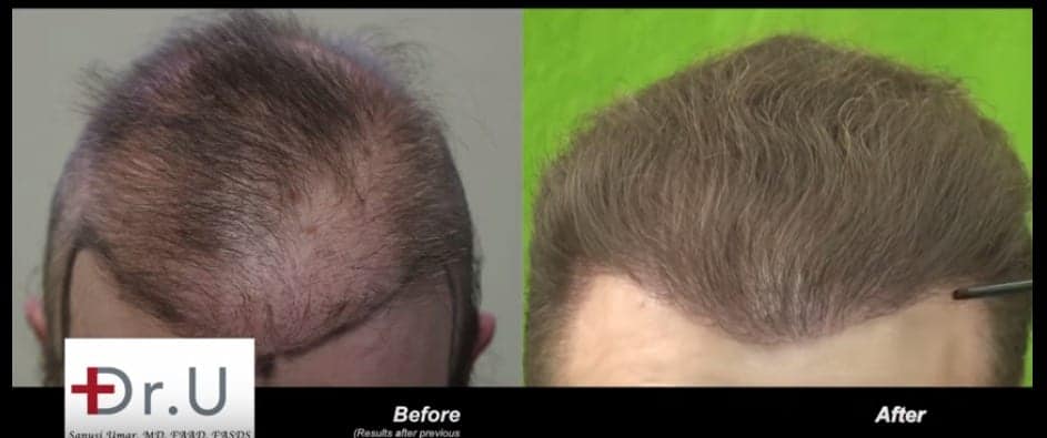 This hair repair patient of Dr. U benefited from 6500 grafts derived from the beard, scalp, nape and chest. The patient felt that his hair transplant cost was completely worth the expenditure