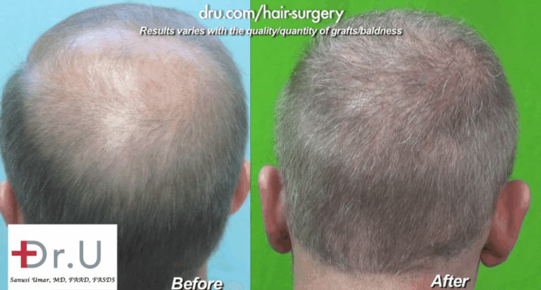 View of Crown for Norwood 6 before and after Dr.UGraft Surgery